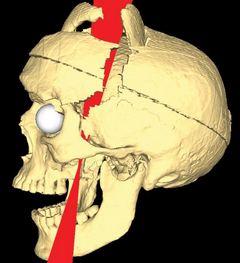 [ Phineas Gage Probable Paths pic ]